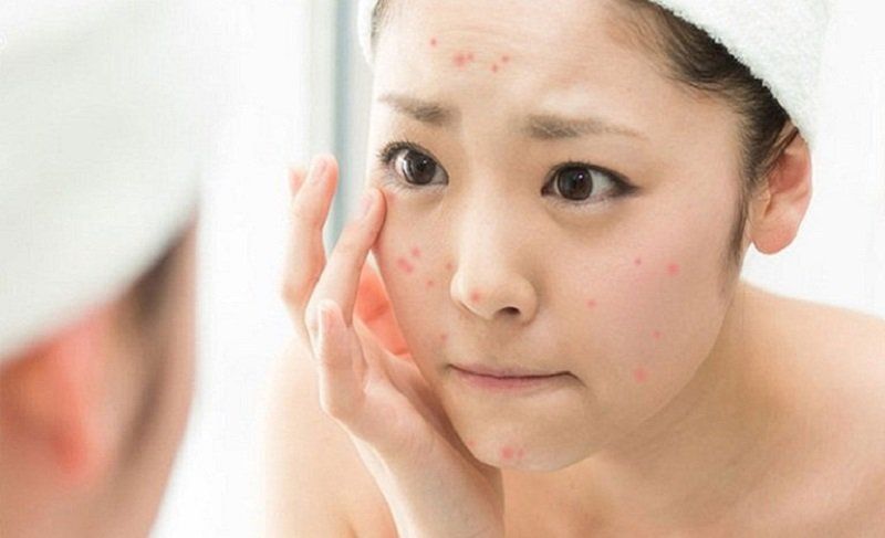 Da dầu mụn vẫn cần sản phẩm làm sạch dịu nhẹ để bảo vệ hàng rào da và hạn chế kích ứng khi chăm sóc da hằng ngày. 