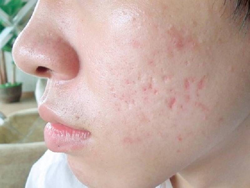 Nên khám bác sĩ da liễu khi lỗ chân lông đi kèm mụn viêm, sẹo lõm, đỏ rát hoặc không cải thiện sau thời gian chăm sóc. 